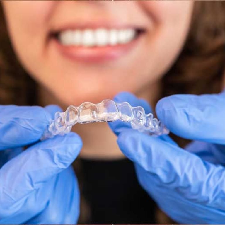 aligners